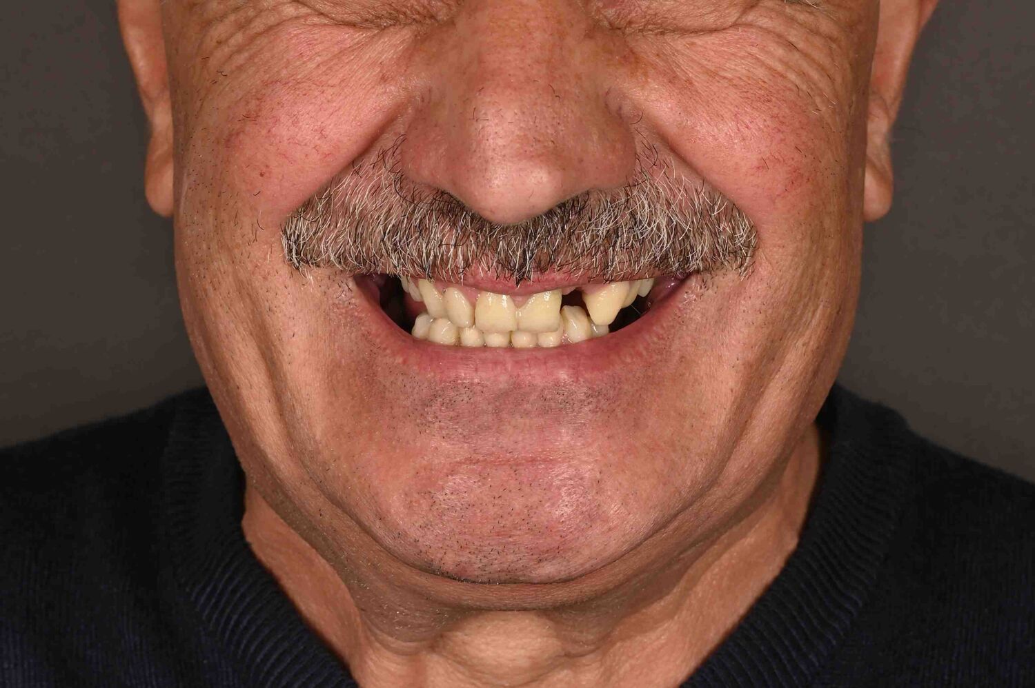 Pacient Clinica Dr. Alin Odor - Rezultat Implantologie